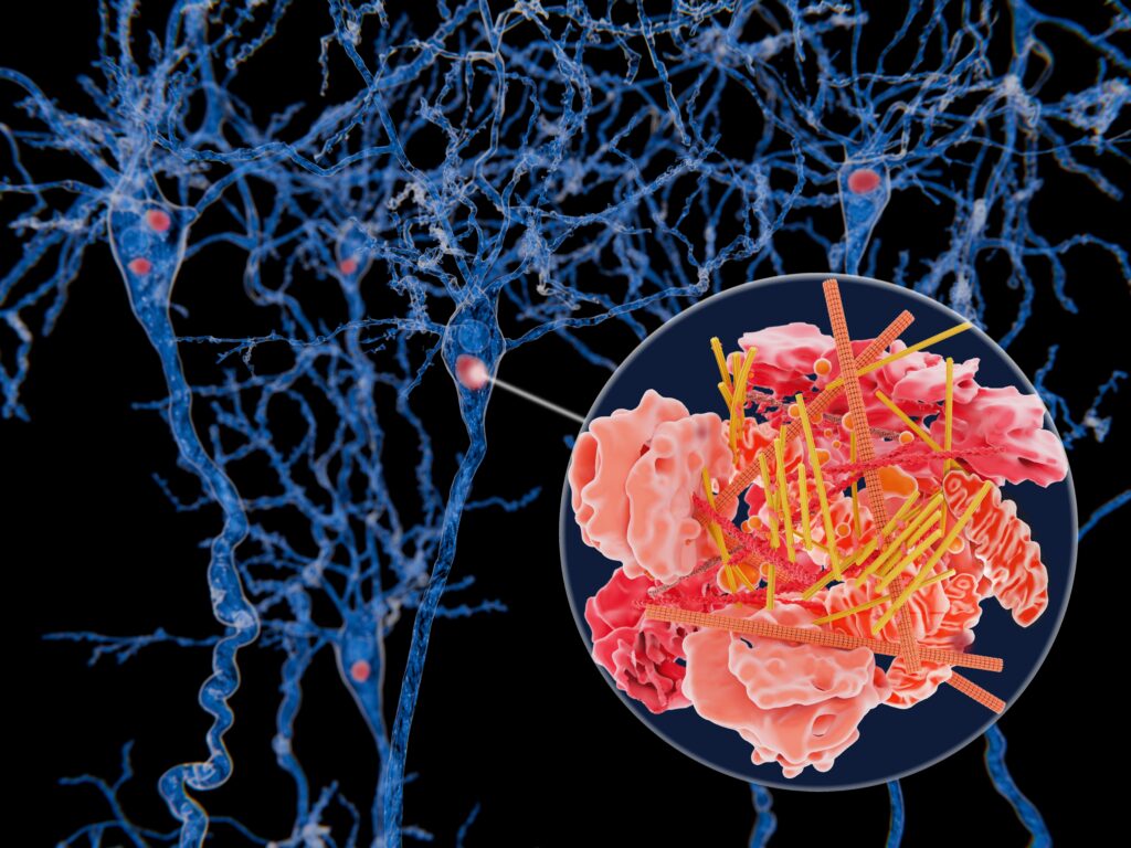 Lewy Bodies Understanding Extreme Symptoms of Lewy Body Dementia